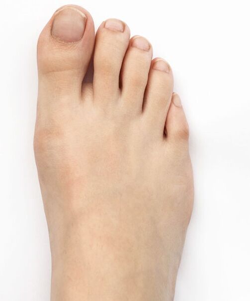 Curé mi pulgar valgo con el spray Hondro Sol Valgus