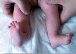 Deformación de valgo en los síntomas de los niños