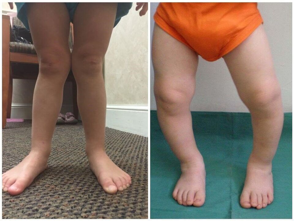 La deformación del valgo en los niños causa