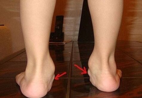 Deformación de valgo de los pies en niños