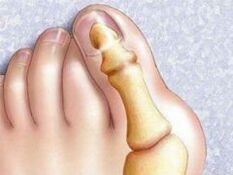 Deformidad hallux valgus