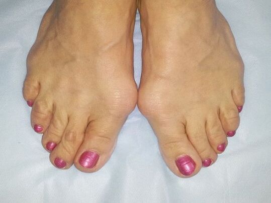 Hallux valgus deformidad de los pies