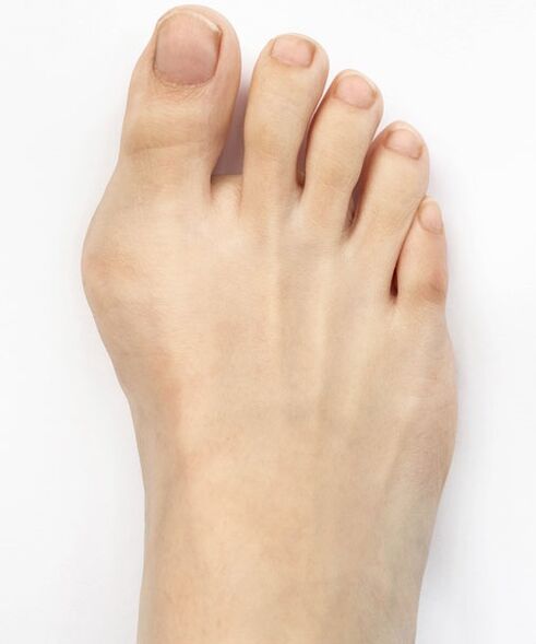hallux valgus antes de usar el spray Hondro Sol Valgus